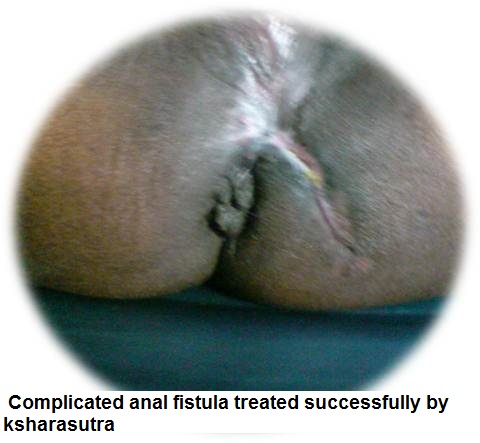 Anal fistula- ksharasutra therapy.